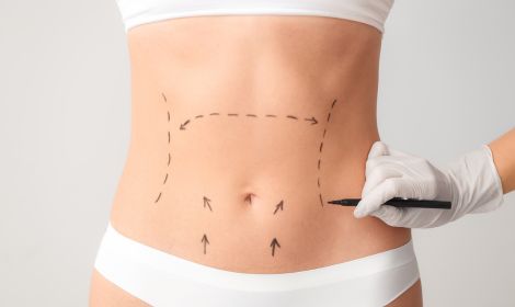 ABDOMINOPLASTIA